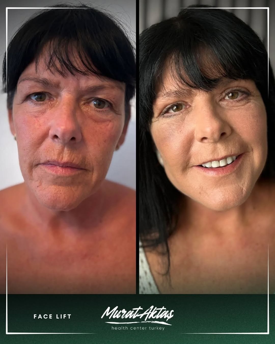 FACE LIFT