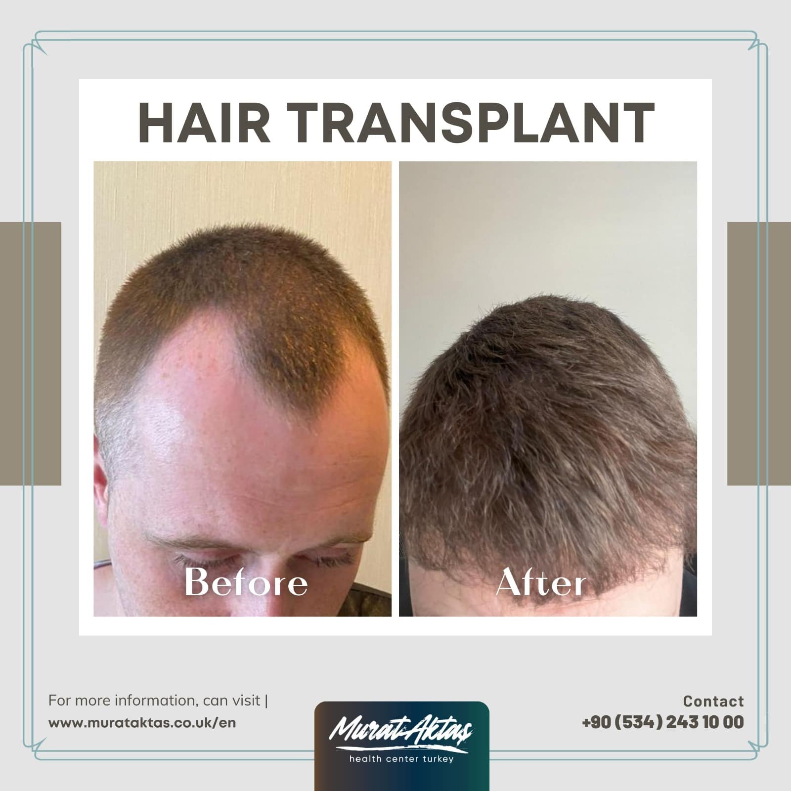 HairTransplant