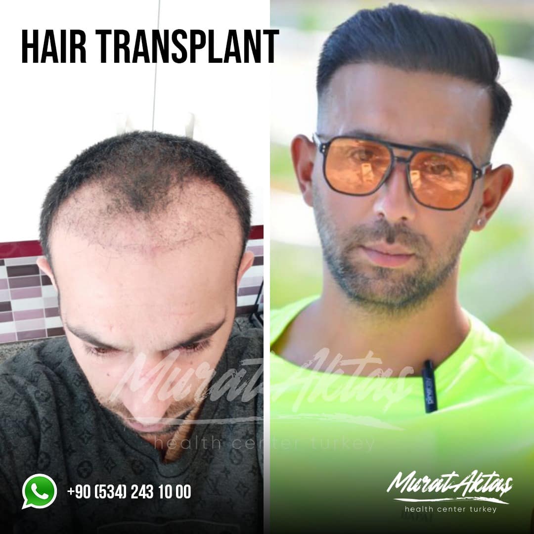 HairTransplant14