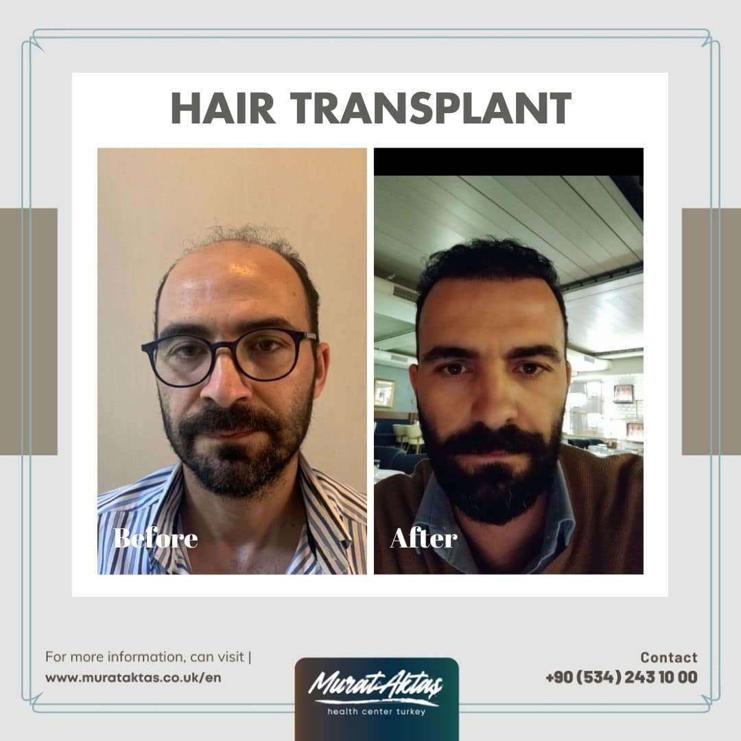 HairTransplant7